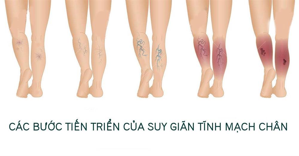suy giãn tĩnh mạch
