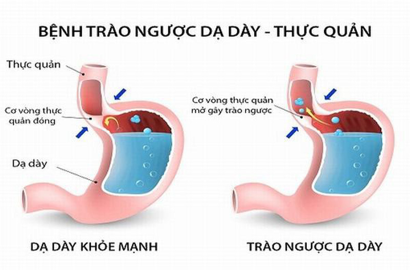 trào ngược dạ dày thực quản