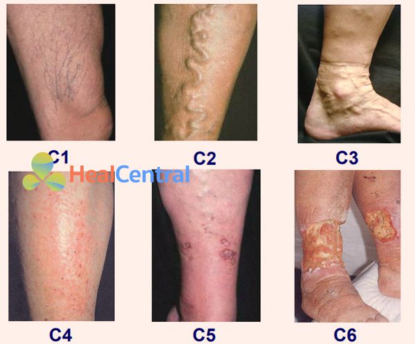 Các mức độ, cấp bậc giứp mô tả rõ hơn về tình trạng bệnh suy giãn tĩnh mạch chi dưới