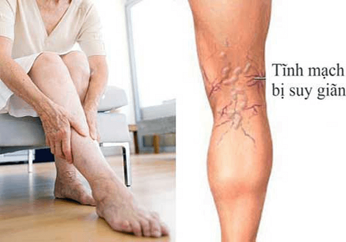 suy giãn tĩnh mạch ở người cao tuổi