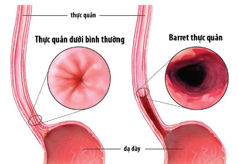 trào ngược  dạ dày thực quản