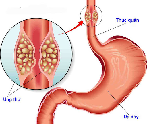 trào ngược dạ dày có thể dẫn đến ung thư thực quản